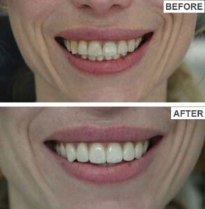 Porcelain Veneers Before and After