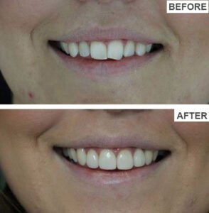 Porcelain Veneers Before and After