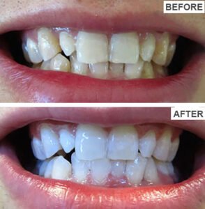 Teeth Cleaning Before and After
