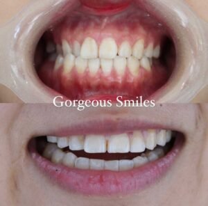 Porcelain Veneers Before and After